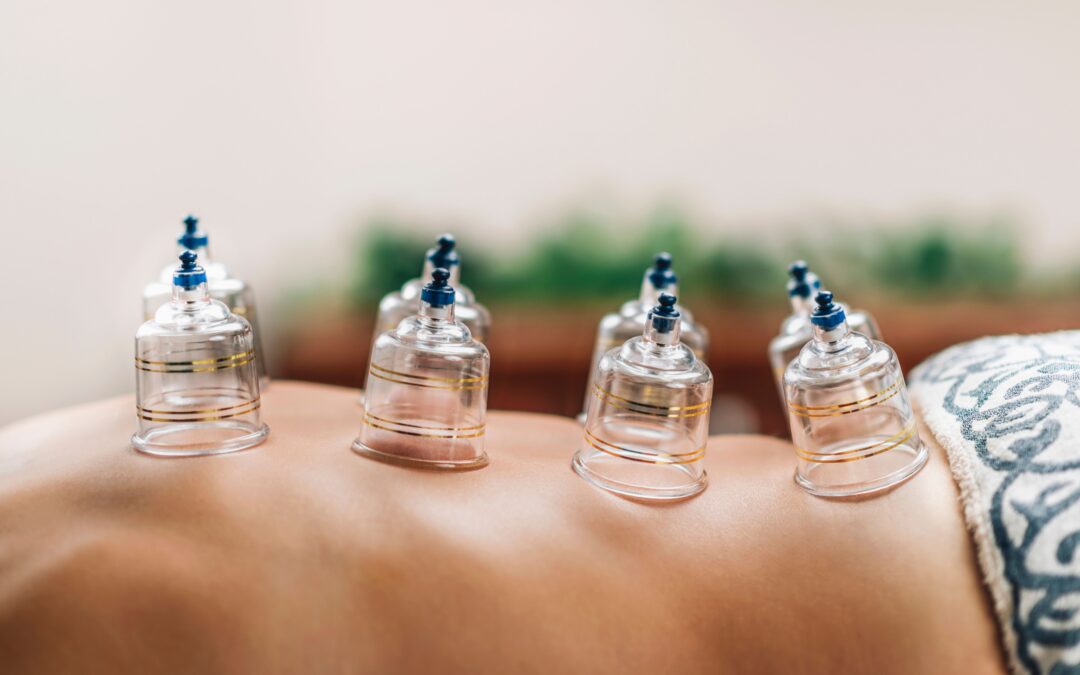 De Voordelen van Cupping Massage 